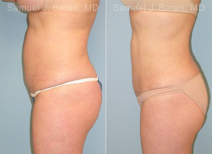 Liposuction Before and After Photos in Montvale, NJ, Patient 12898