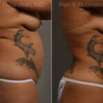 Smart Lipo Body Before and After Photos in Montvale, NJ, Patient 13222