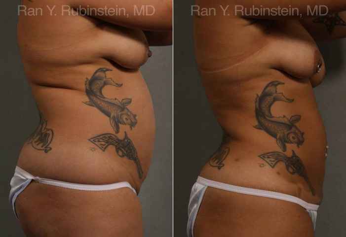 Smart Lipo Body Before and After Photos in Montvale, NJ, Patient 13222