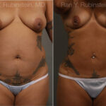 Smart Lipo Body Before and After Photos in Montvale, NJ, Patient 13222