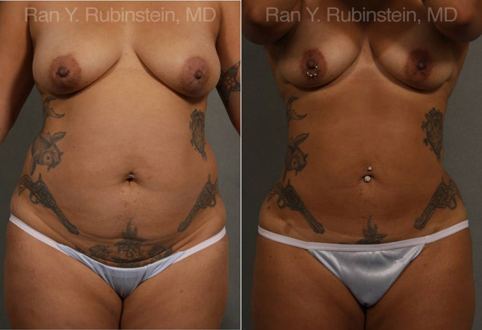 Smart Lipo Body Before and After Photos in Montvale, NJ, Patient 13222