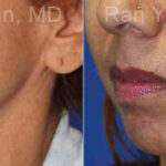 Microneedling RF Before and After Photos in Montvale, NJ, Patient 16594