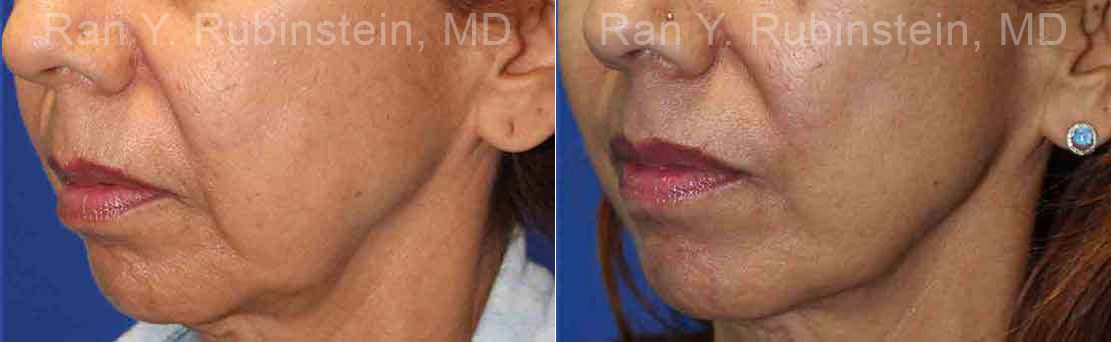patient-16594-microneedling-rf-before-after