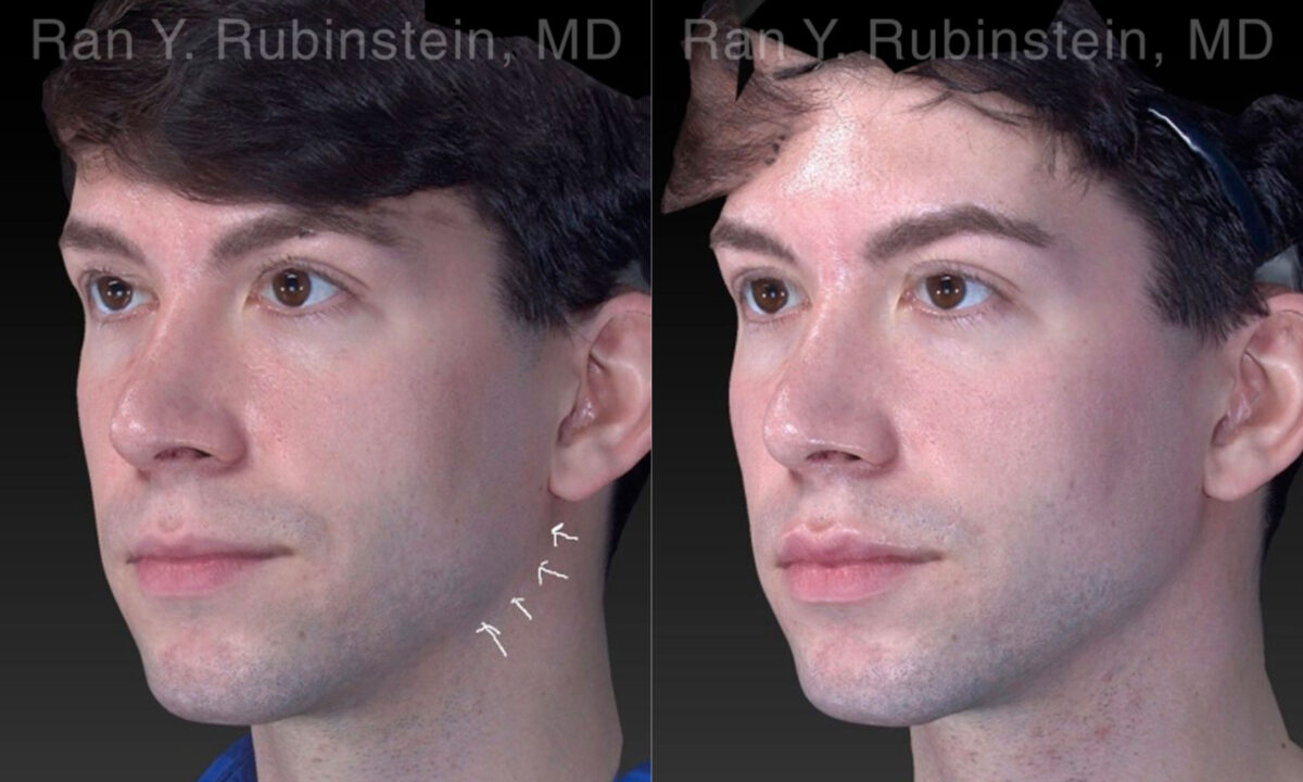 Chin Filler Before and After Photos in Montvale, NJ, Patient 19962
