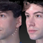Chin Filler Before and After Photos in Montvale, NJ, Patient 19962