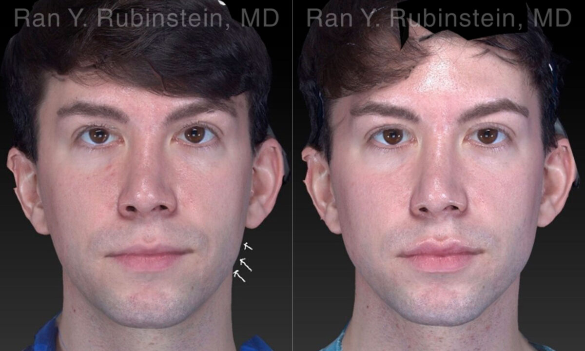 Chin Filler Before and After Photos in Montvale, NJ, Patient 19962