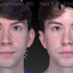 Chin Filler Before and After Photos in Montvale, NJ, Patient 19962