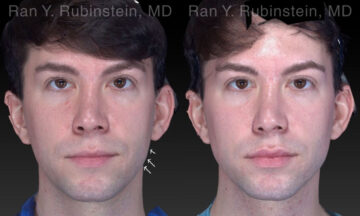 Chin Filler Before and After Photos in Montvale, NJ, Patient 19962