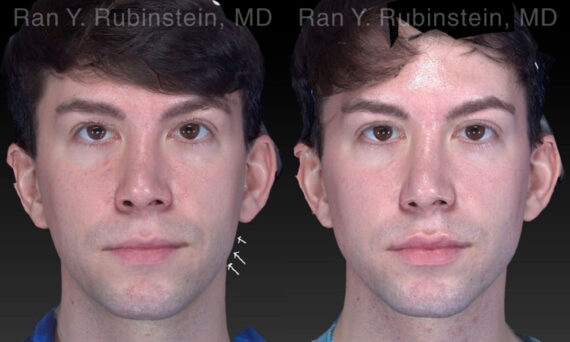 Chin Filler Before and After Photos in Montvale, NJ, Patient 19962
