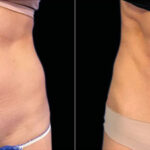 Emsculpt Before and After Photos in Montvale, NJ, Patient 23533
