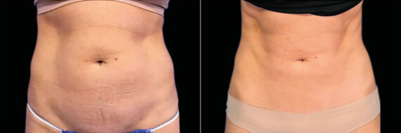 Emsculpt Before and After Photos in Montvale, NJ, Patient 23533