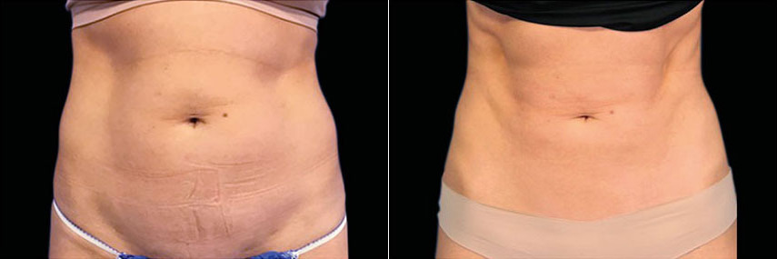 Emsculpt Before and After Photos in Montvale, NJ, Patient 23533