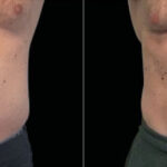 Emsculpt Before and After Photos in Montvale, NJ, Patient 23537