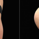 Emsculpt Before and After Photos in Montvale, NJ, Patient 23541