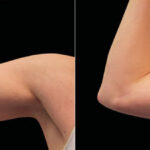 Emsculpt Before and After Photos in Montvale, NJ, Patient 23545