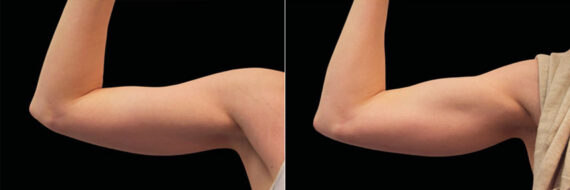 Emsculpt Before and After Photos in Montvale, NJ, Patient 23545
