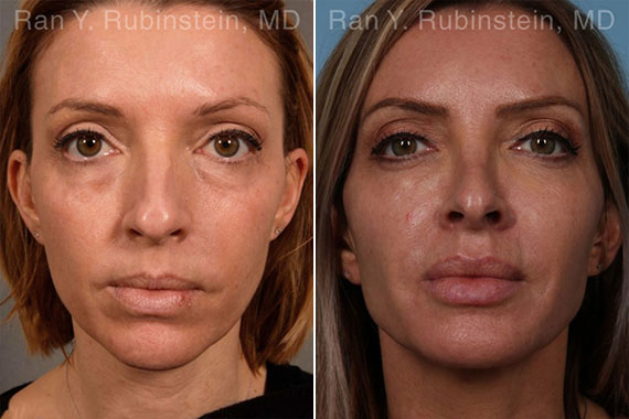 Sculptra Face Before & After Photos