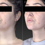 Kybella Before and After Photos in Montvale, NJ, Patient 23658