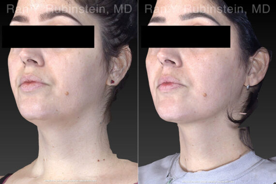 Kybella Before and After Photos in Montvale, NJ, Patient 23658