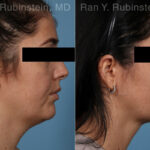 Kybella Before and After Photos in Montvale, NJ, Patient 23658