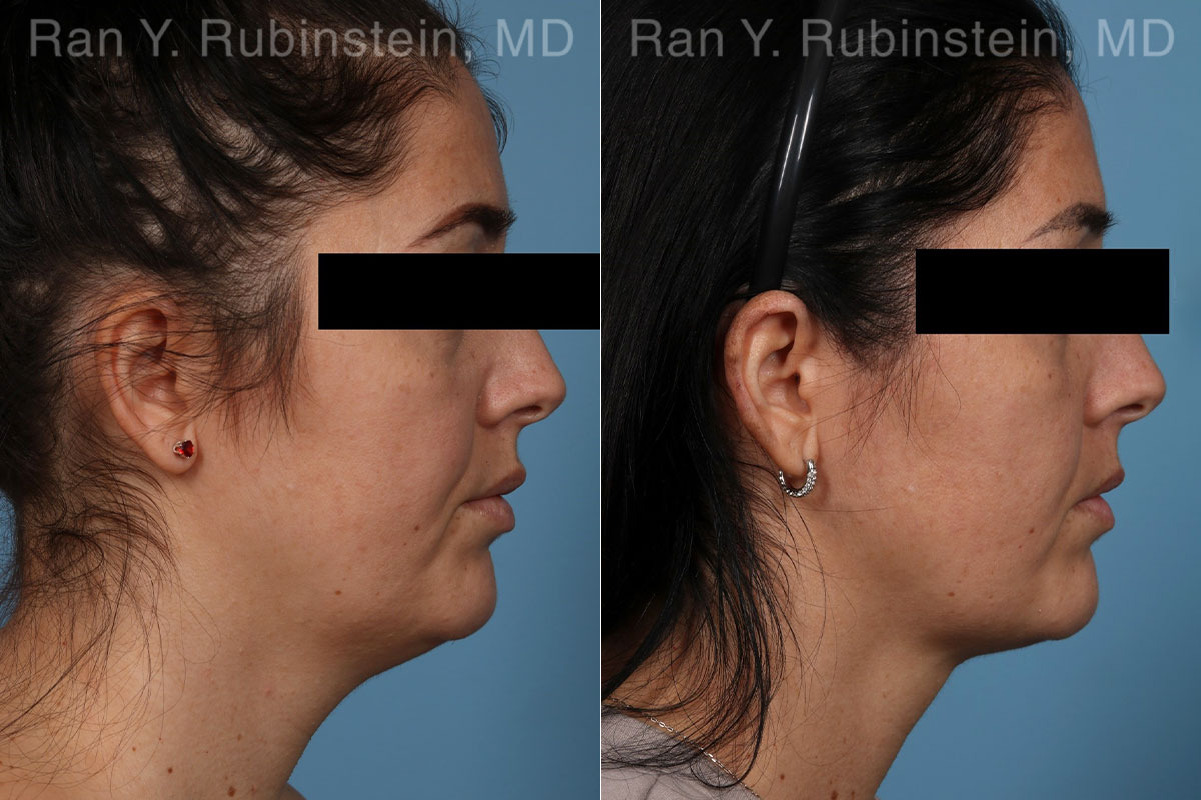 Kybella Before and After Photos in Montvale, NJ, Patient 23658