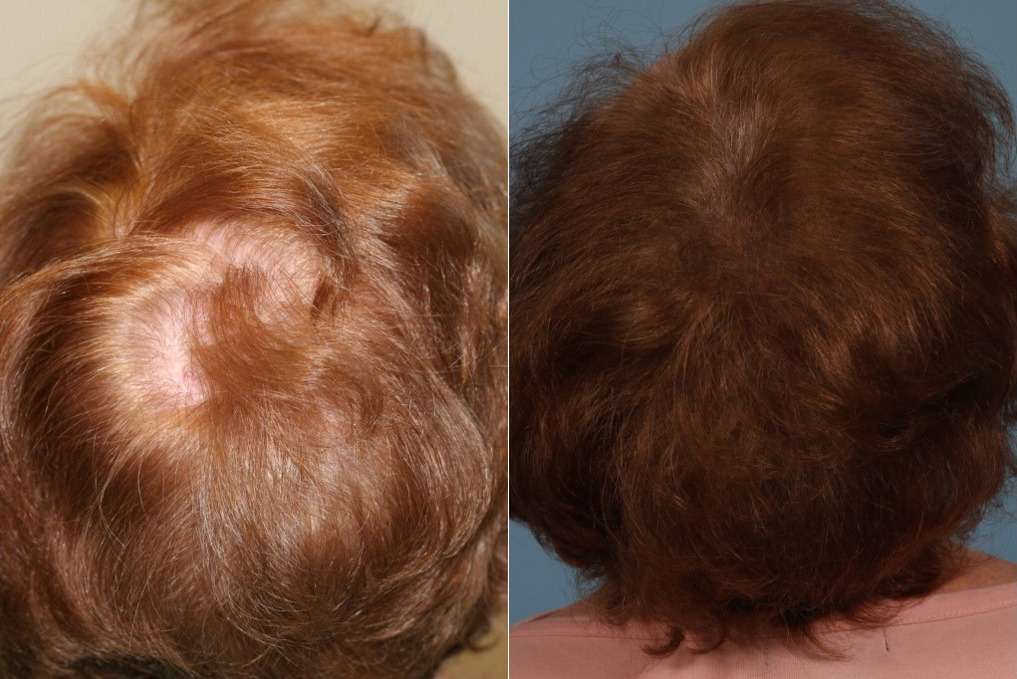 PRP Hair Restoration Before and After