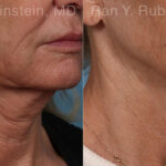 Microneedling RF Before and After Photos in Montvale, NJ, Patient 23835