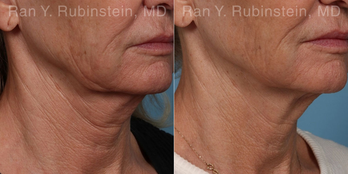 Microneedling RF Before and After Photos in Montvale, NJ, Patient 23835