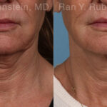 Microneedling RF Before and After Photos in Montvale, NJ, Patient 23835
