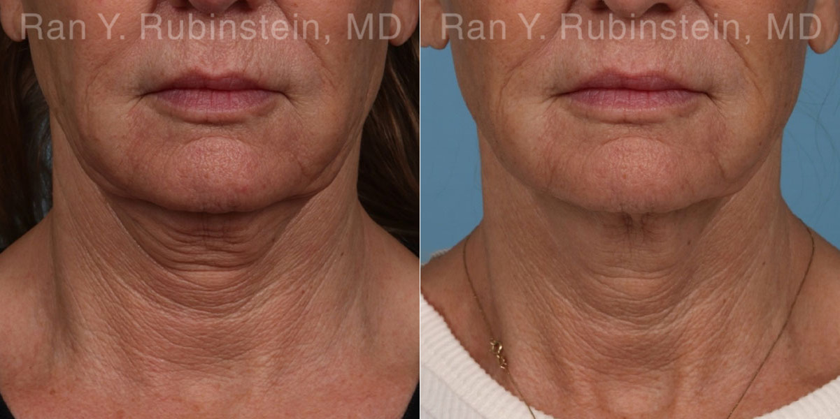 patient-23835-microneedling-rf-before-after