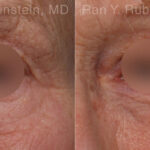 Microneedling RF Before and After Photos in Montvale, NJ, Patient 23843