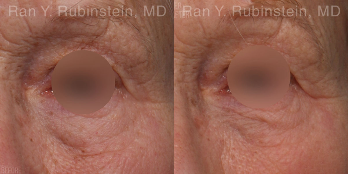 Microneedling RF Before and After Photos in Montvale, NJ, Patient 23843