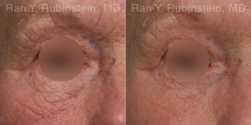 Microneedling RF Before and After Photos in Montvale, NJ, Patient 23843