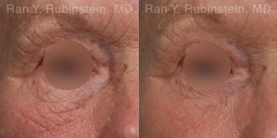 Microneedling RF Before and After Photos in Montvale, NJ, Patient 23843