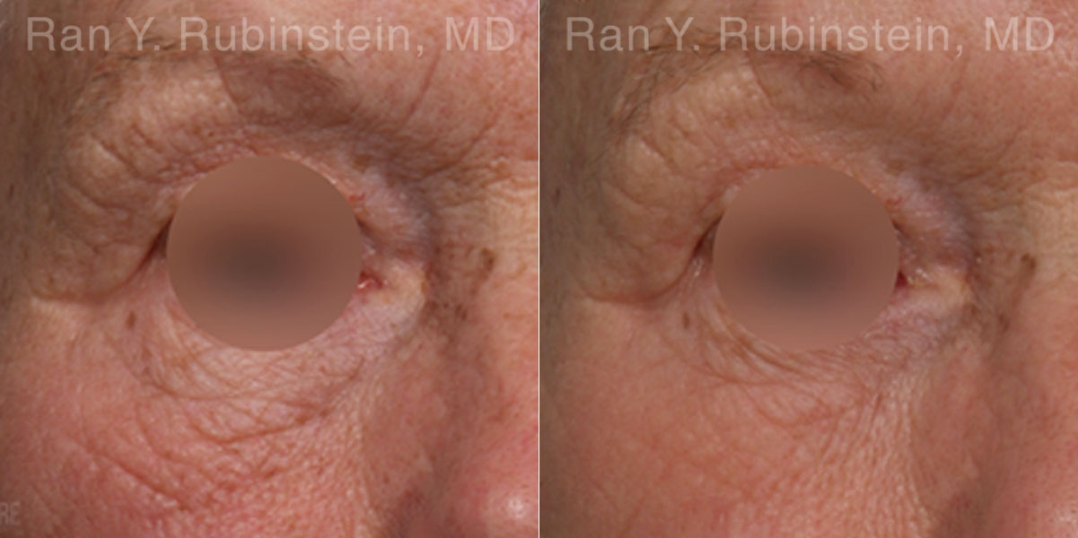 Microneedling RF Before and After Photos in Montvale, NJ, Patient 23843