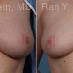 Laser Treatments Before and After Photos in Montvale, NJ, Patient 23851