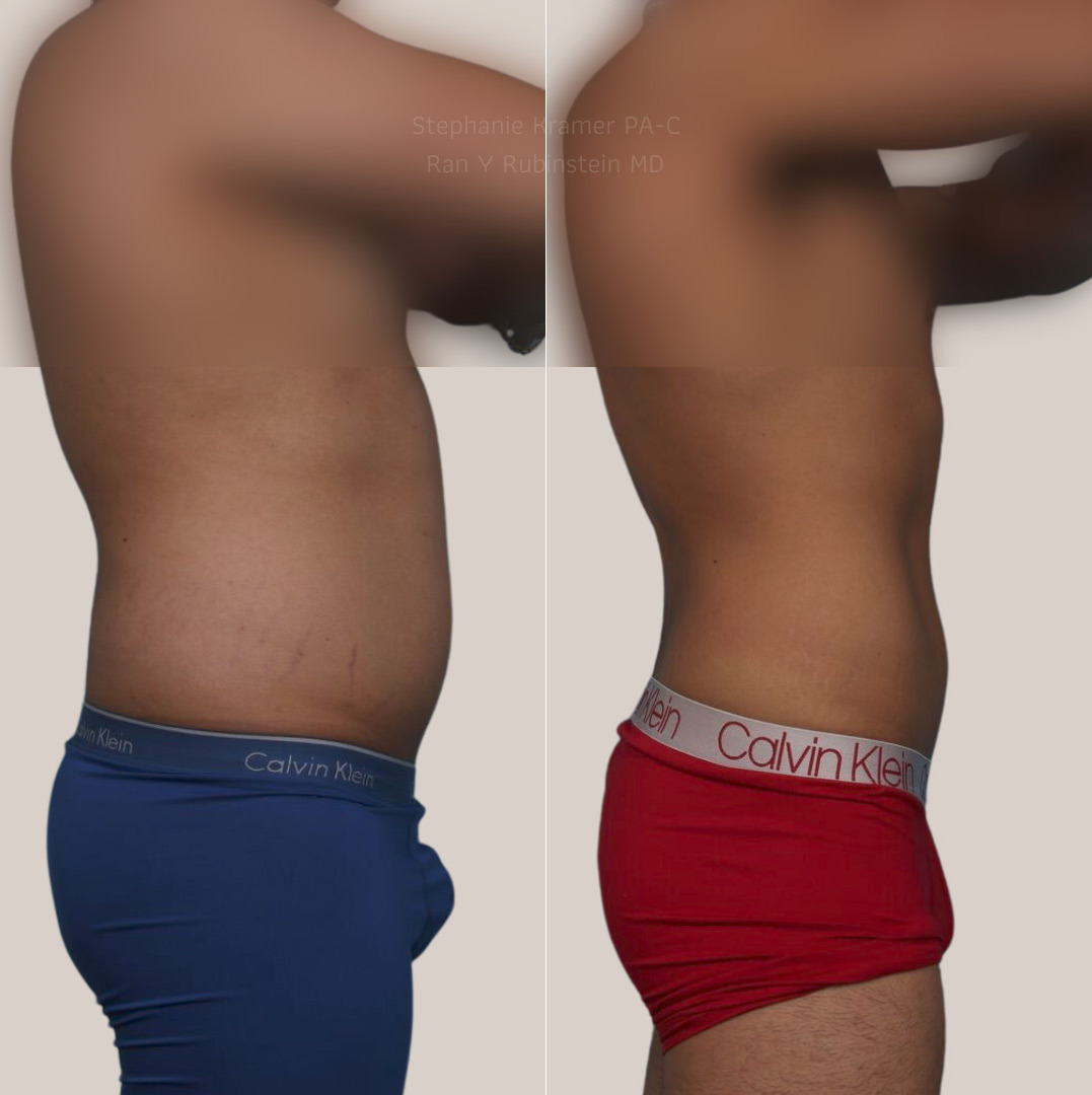 Coolsculpting Elite Before and After Photos in Montvale, NJ, Patient 23927