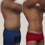 Coolsculpting Elite Before and After Photos in Montvale, NJ, Patient 23927