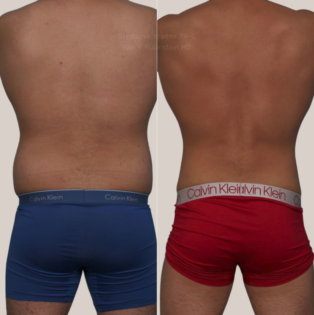 Coolsculpting Elite Before and After Photos in Montvale, NJ, Patient 23927