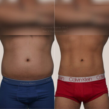 Coolsculpting Elite Before and After Photos in Montvale, NJ, Patient 23927