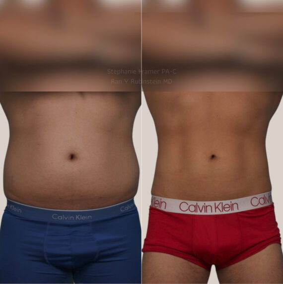 Coolsculpting Elite Before and After Photos in Montvale, NJ, Patient 23927