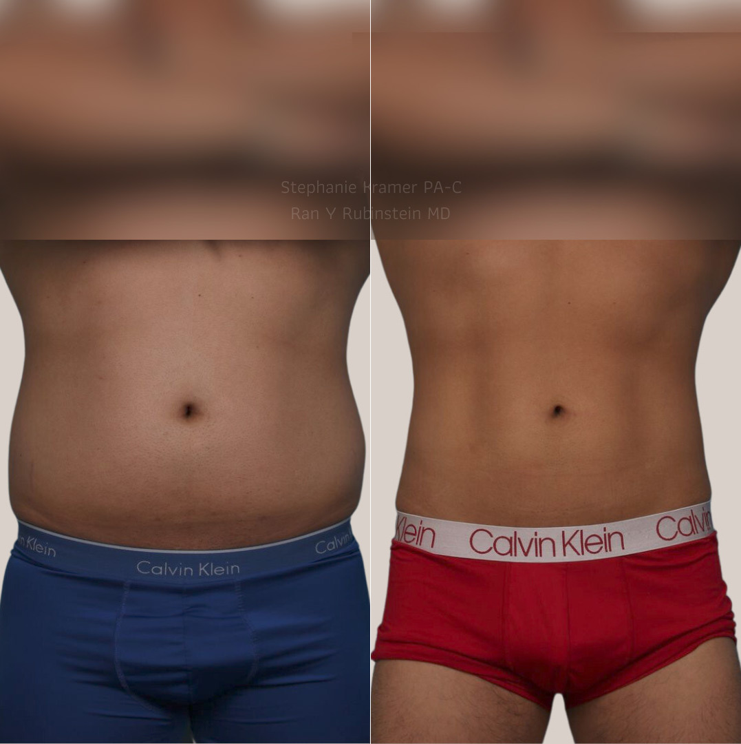 Coolsculpting Elite Before and After Photos in Montvale, NJ, Patient 23927
