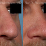 Rhinoplasty Before and After Photos in Montvale, NJ, Patient 23944