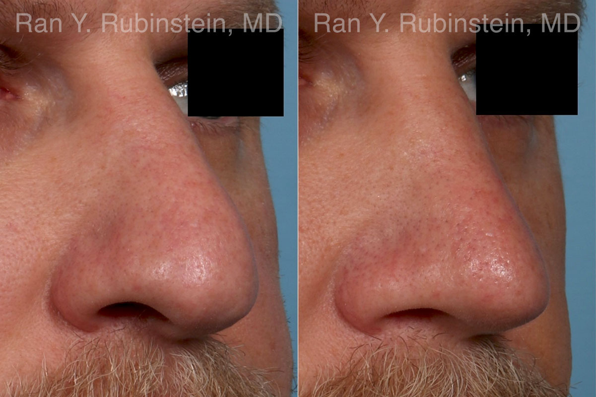 Rhinoplasty Before and After Photos in Montvale, NJ, Patient 23944