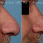 Rhinoplasty Before and After Photos in Montvale, NJ, Patient 23944