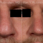 Rhinoplasty Before and After Photos in Montvale, NJ, Patient 23944