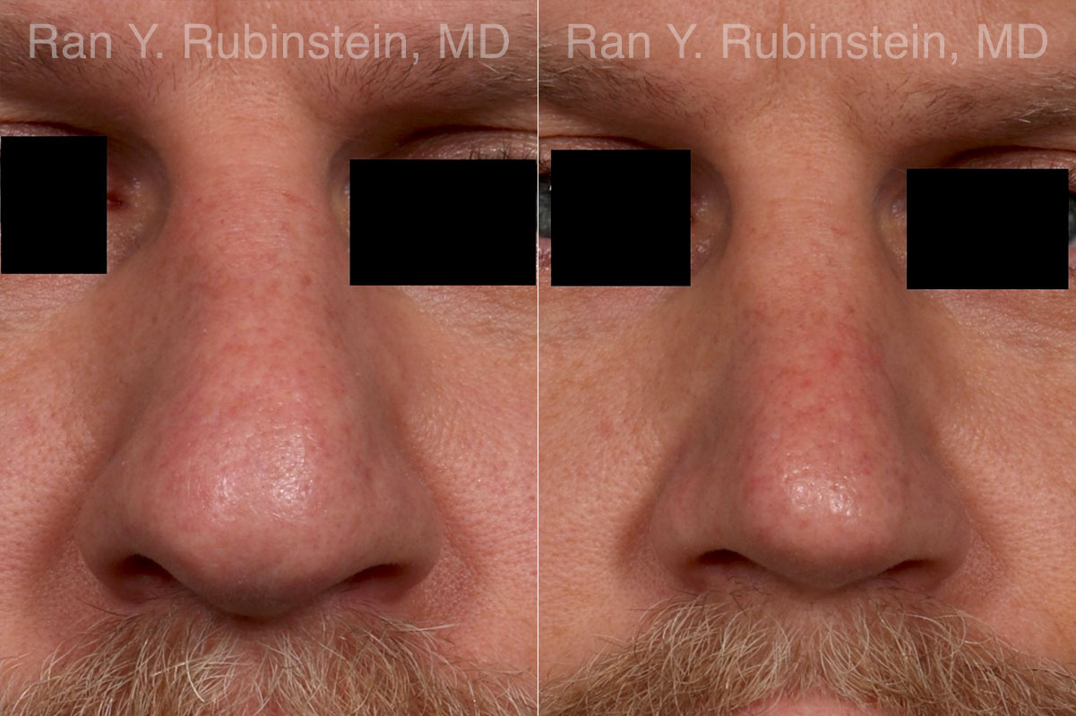 Rhinoplasty Before and After Photos in Montvale, NJ, Patient 23944