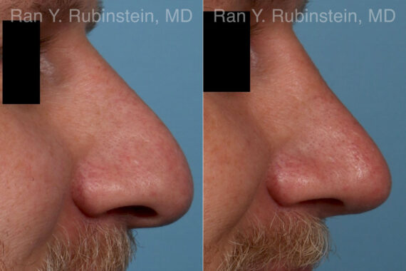 Rhinoplasty Before and After Photos in Montvale, NJ, Patient 23944