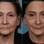 Face lift & Neck lift Before and After Photos in Montvale, NJ, Patient 24509