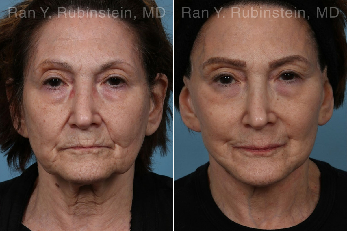 Face lift & Neck lift Before and After Photos in Montvale, NJ, Patient 24509